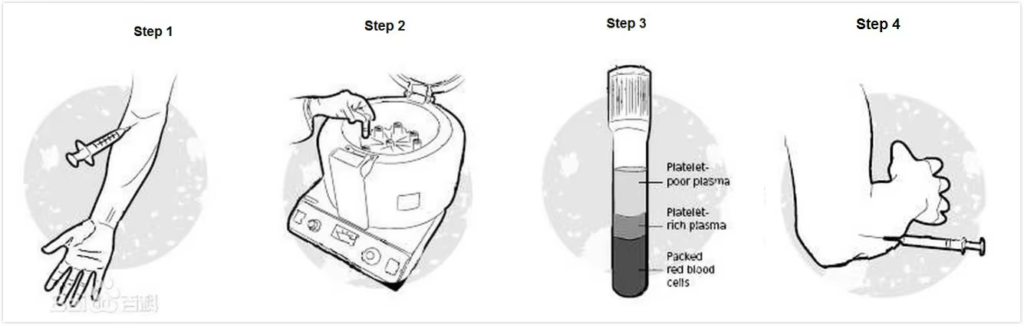 PRP Centrifuge